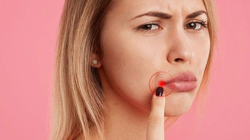 how to get rid of angular cheilitis